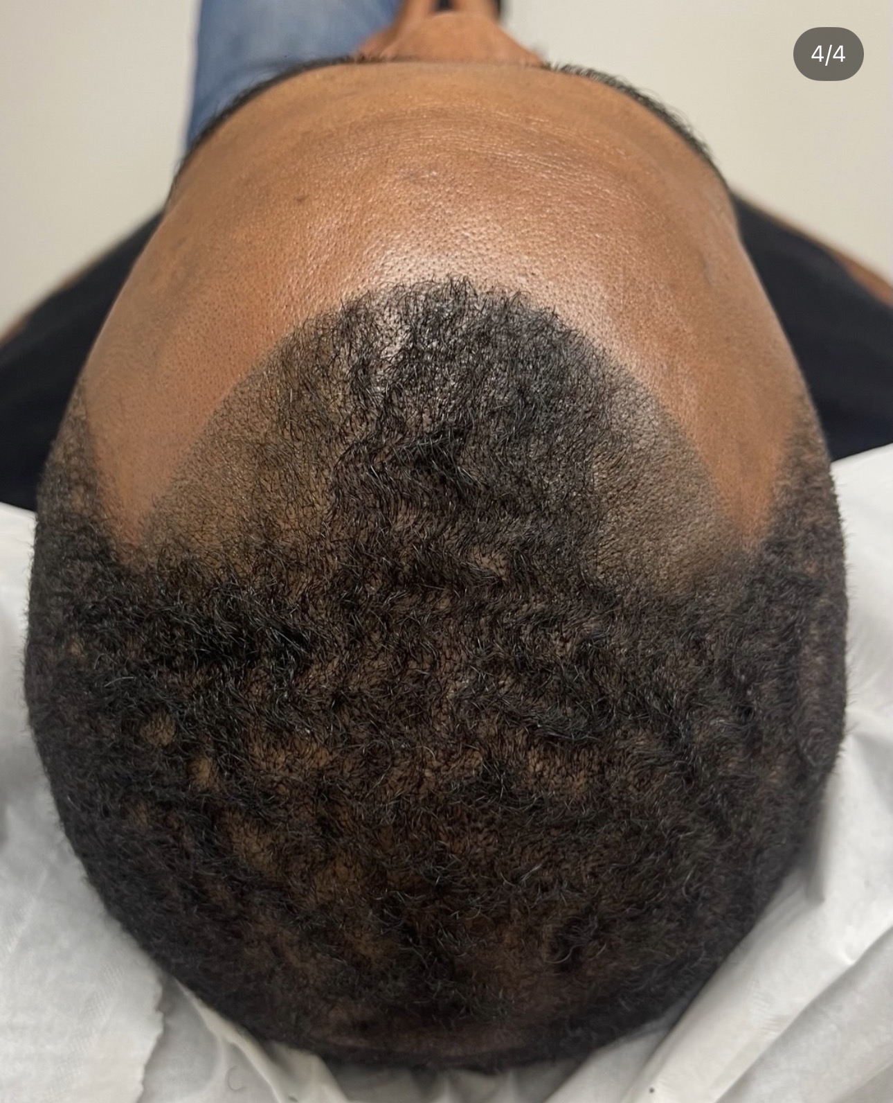 Ligne frontale après tricopigmentation