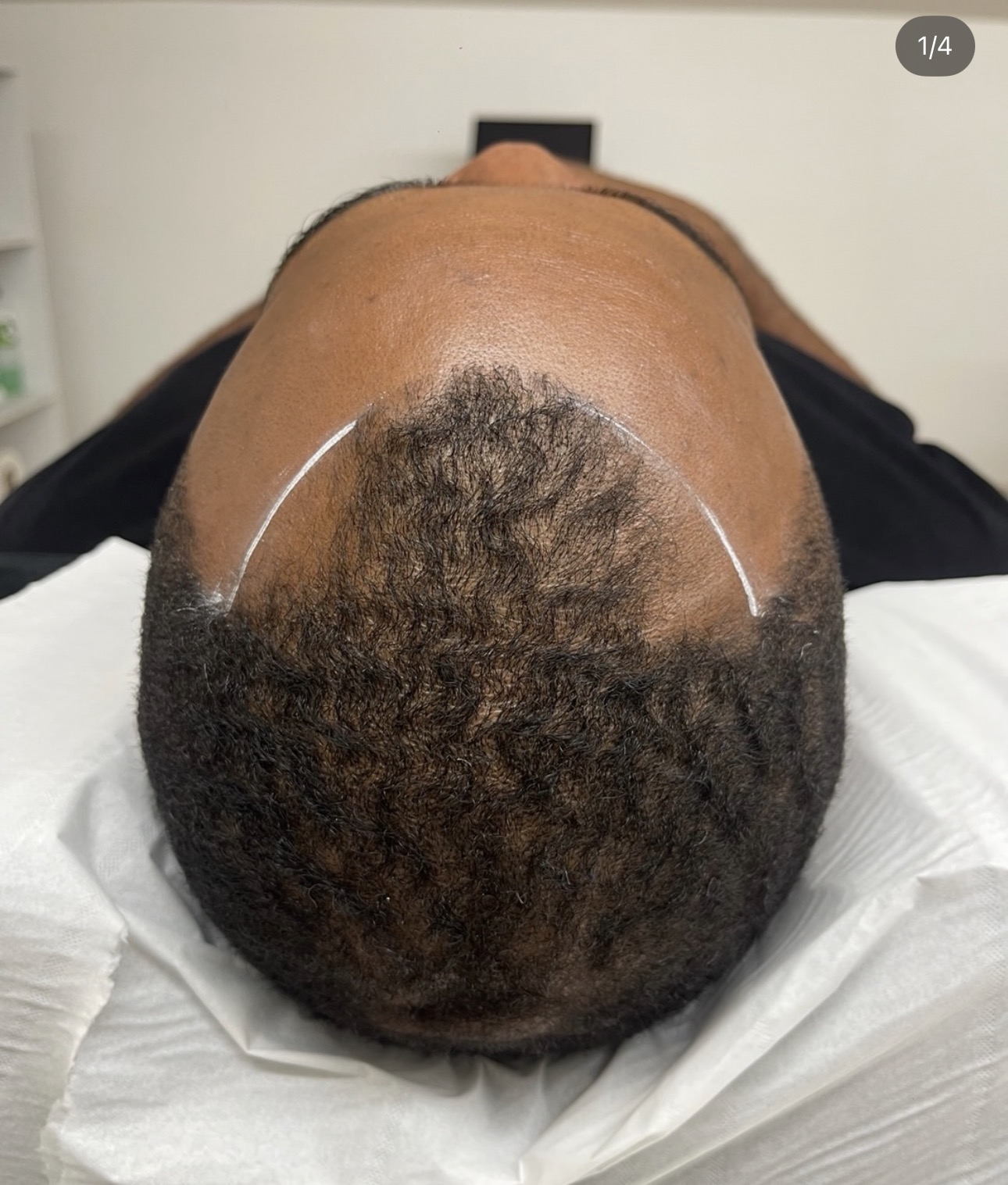 Tracé de ligne frontale avant tricopigmentation