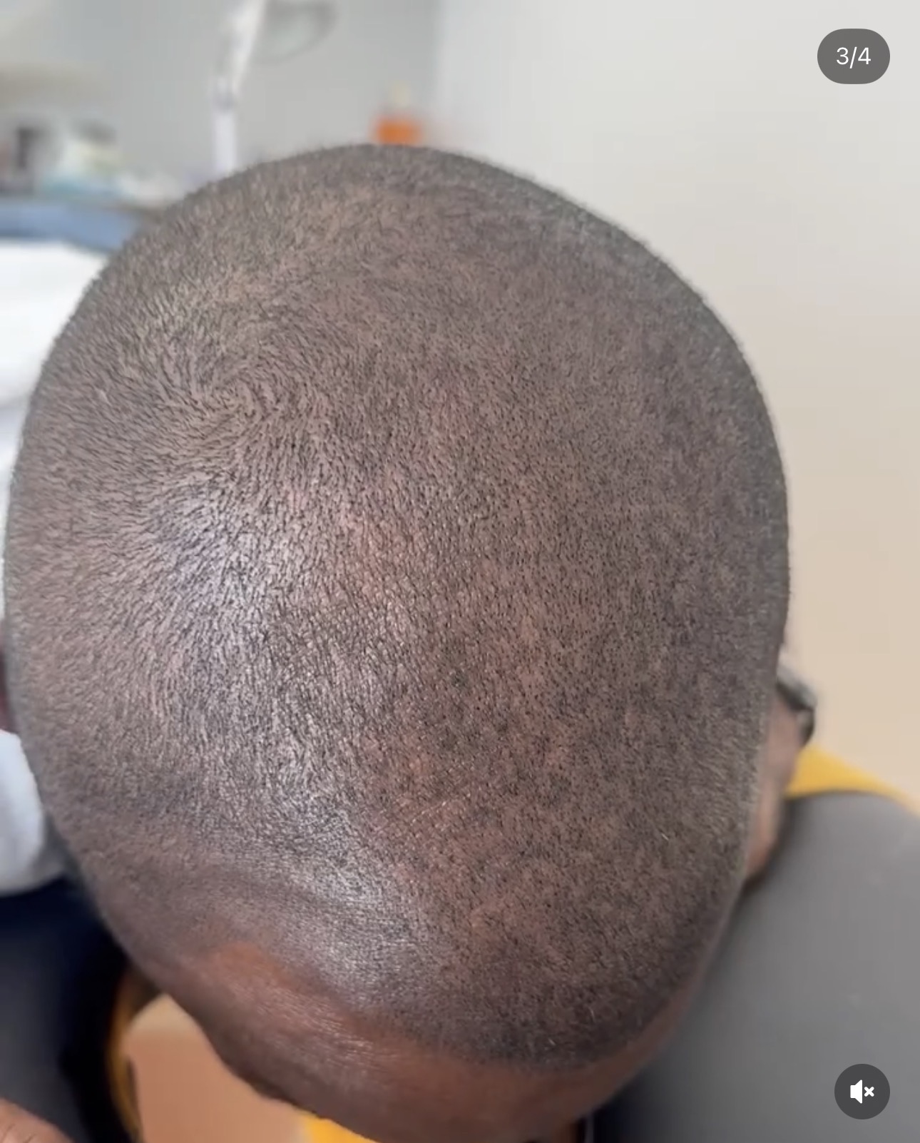 Vue arrière après tricopigmentation